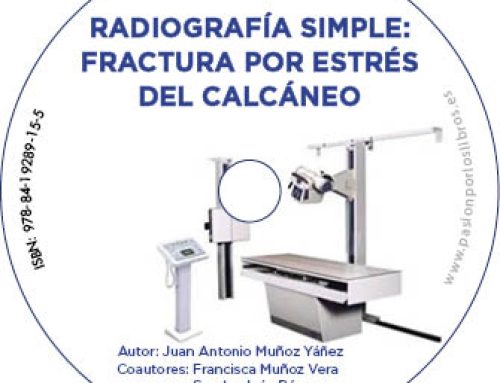 Radiografía simple: fractura por estrés del calcáneo